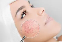 Hajszáleres bőr: Tünetek, kezelések, szépségápolási termékek